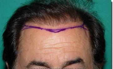 Hair restoration procedure results