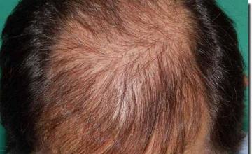 Hair restoration procedure results