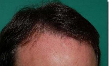 Hair restoration procedure results