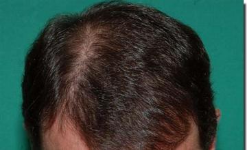 Hair restoration procedure results