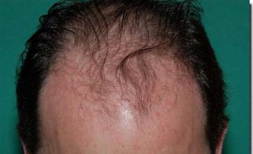 Hair restoration procedure results