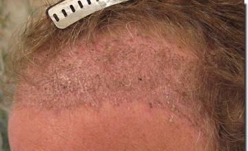 Hair restoration procedure results