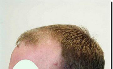 Hair restoration procedure results