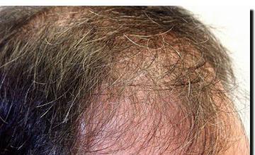 Hair restoration procedure results