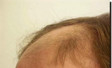 Hair restoration procedure results