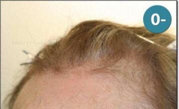 Hair restoration procedure results