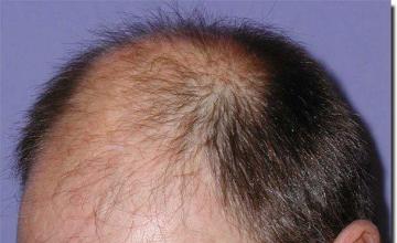 Hair restoration procedure results