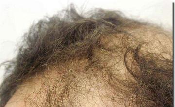 Hair restoration procedure results