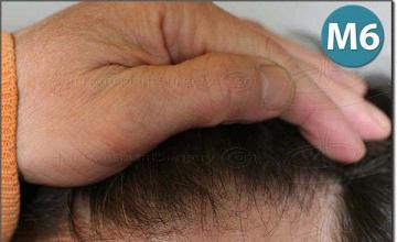 Hair restoration procedure results