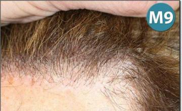 Hair restoration procedure results