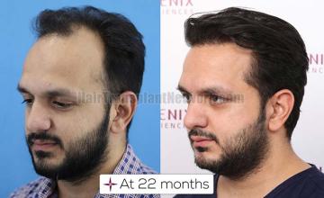 Left view before and after hair transplant surgery