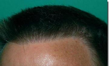 Hair restoration procedure results