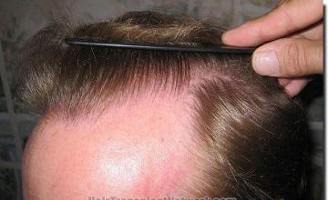 Hair restoration procedure results