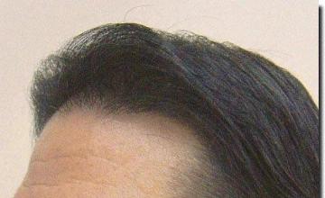 Hair restoration procedure results