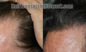 Left view of the hair transplant results