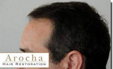 Hair restoration procedure results