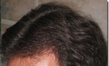 Hair restoration procedure results