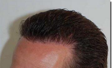 Hair restoration procedure results