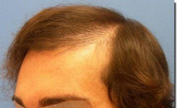 Hair restoration procedure results