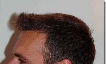 Hair restoration procedure results