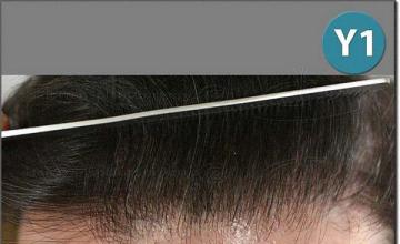 Hair restoration procedure results