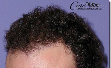 Hair restoration procedure results