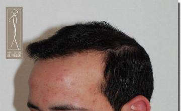 Hair restoration procedure results