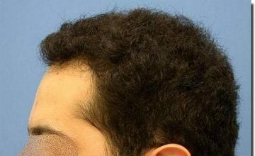 Hair restoration procedure results