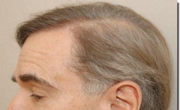 Hair restoration procedure results