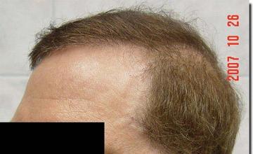 Hair restoration procedure results