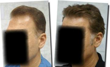 Hair restoration procedure results