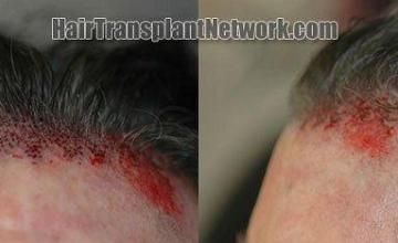 Surgial detail of the hair transplant