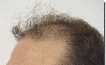 Hair restoration procedure results