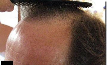 Hair restoration procedure results