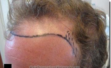 Hair restoration procedure results