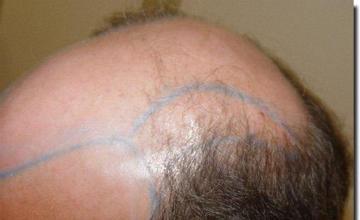 Hair restoration procedure results