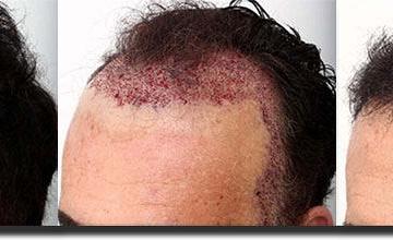 Hair transplantation surgery before and after images