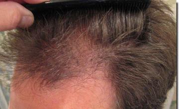 Hair restoration procedure results