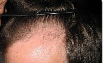 Hair restoration procedure results