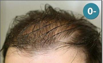 Hair restoration procedure results