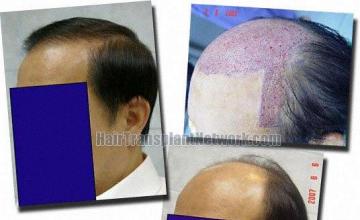 Hair restoration procedure results