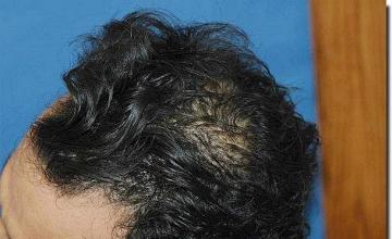 Hair restoration procedure results