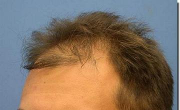 Hair restoration procedure results