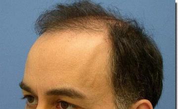 Hair restoration procedure results