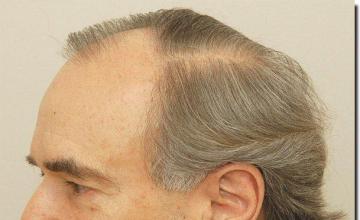 Hair restoration procedure results