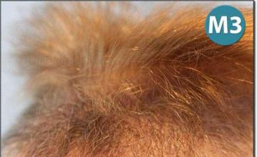 Hair restoration procedure results
