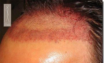 Hair restoration procedure results