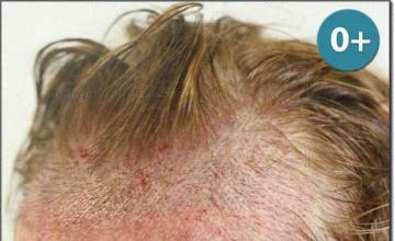 Hair restoration procedure results