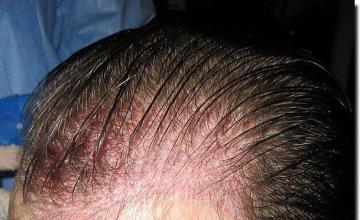 Hair restoration procedure results