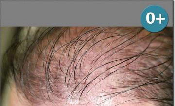 Hair restoration procedure results